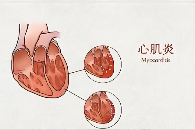 心肌炎的症状有哪些？心肌炎的主要变现症状有啥？